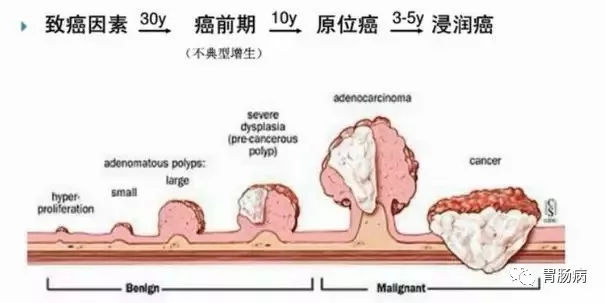體檢查出腸息肉一定要切除! 95%腸癌由它演變而來(lái)