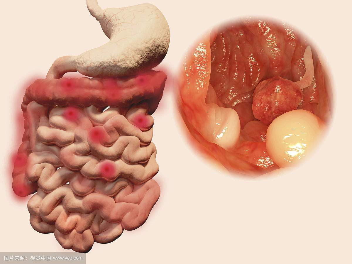 南寧慢性腸炎的費用是多少錢(qián)