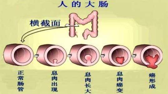 南寧治療結腸炎要多少費用