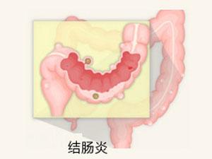 南寧治療結腸炎哪家醫院好