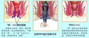 南寧肛腸醫院 南寧醫博中醫肛腸醫院 南寧看痔瘡的醫院 南寧肛瘺醫院 南寧肛裂醫院 南寧腸炎醫院