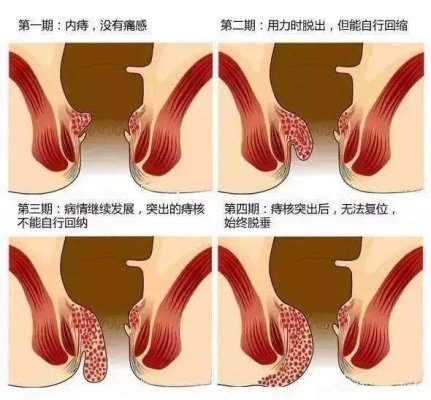 南寧肛門(mén)息肉手術(shù)要多少錢(qián)