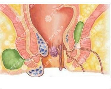 南寧哪個(gè)醫院可以做肛周膿腫？